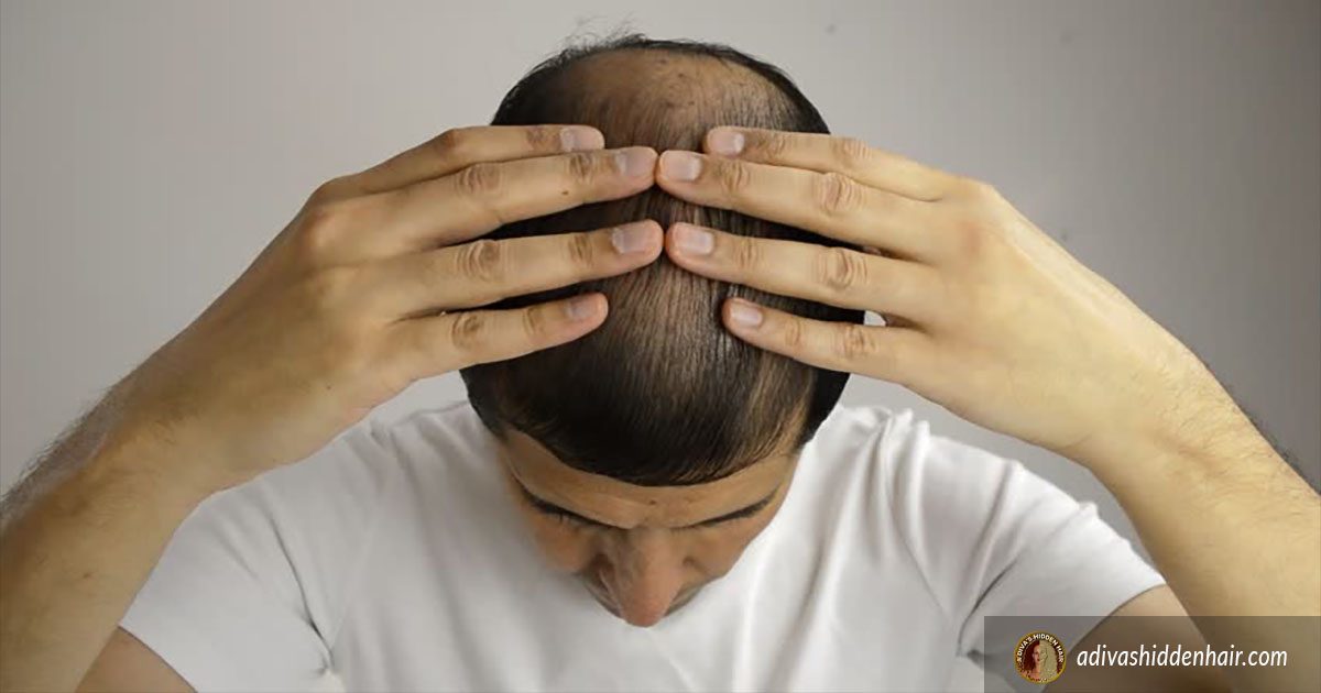 Common Causes Of Hair Loss