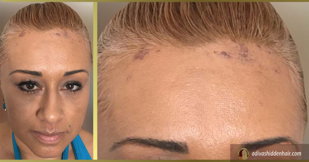 frontal-fibrosing-alopecia-how-women-are-conquering-their-hairline
