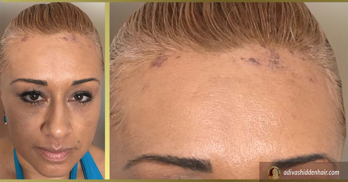 Frontal Fibrosing Alopecia: How Women Are Conquering Their Hairline Blues