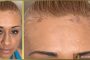 Frontal Fibrosing Alopecia