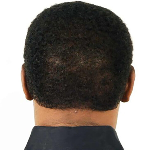 Hair Replacement System For African American Men